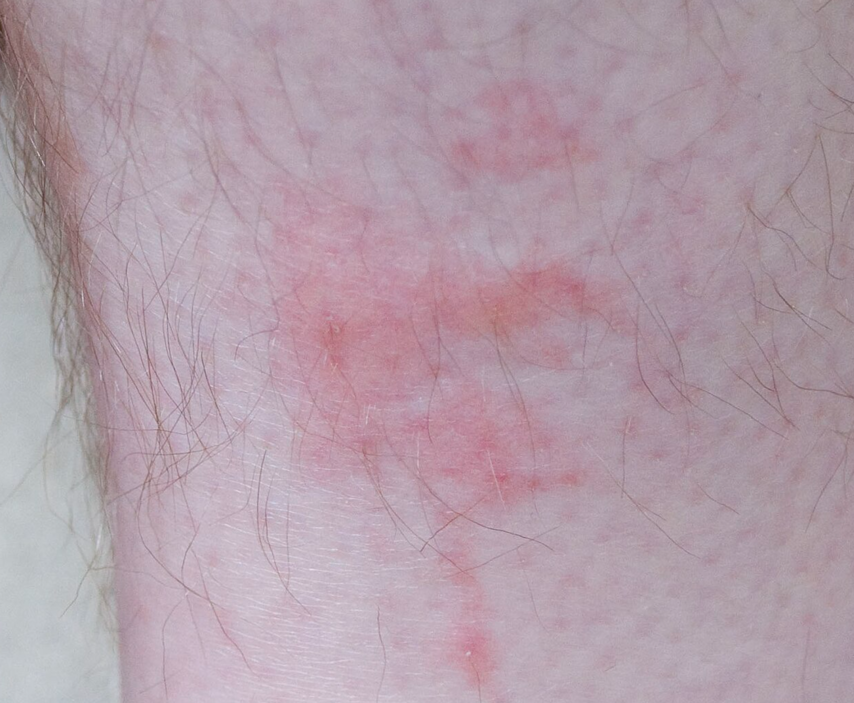 Marques de piqûres pouvant être associées aux punaises de lit sur une jambe